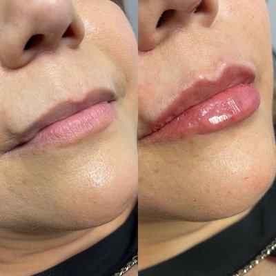 Restylane Kysse on lips