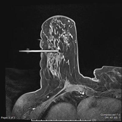 Breast Biopsy performed at OAI.