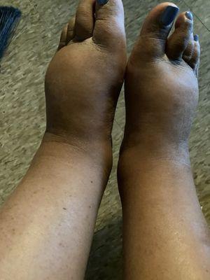 PAD. Lymphedema, edema,hormonal issues, thyroid conditions: all  left untreated.