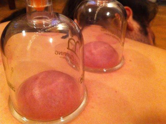 Cupping therapy