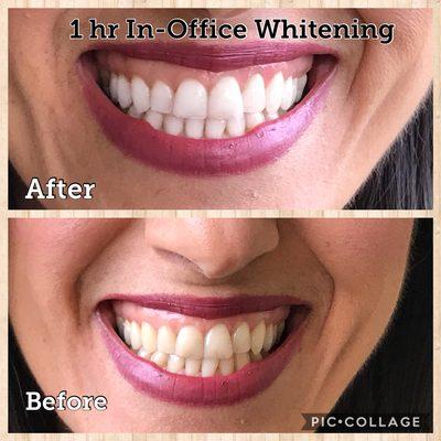 1 hr in-office Teeth Whitening- Cosmetic Dentistry