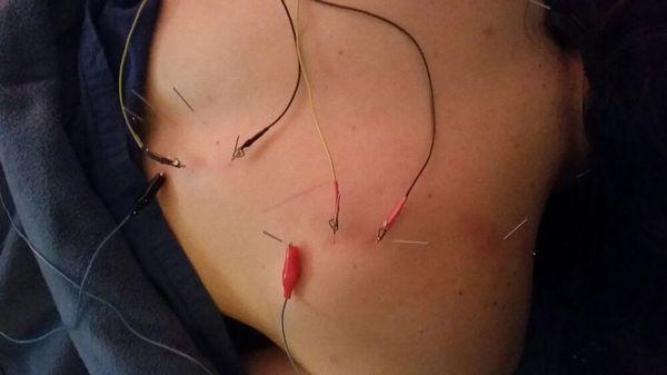 Using electro stymulation at acupunture sights to relieve pain and encourage recovery.