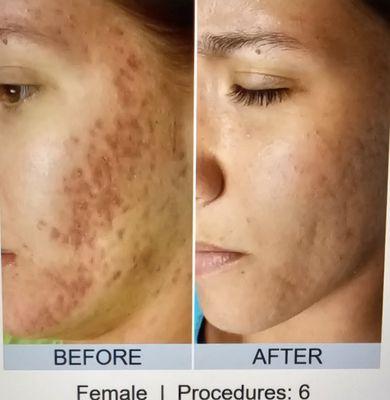 Microneedling real results.