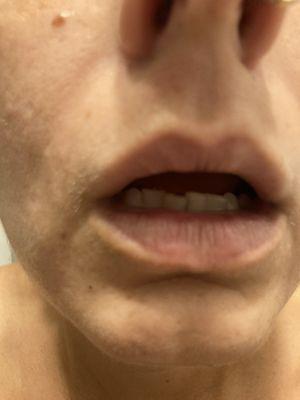 Scar tissue upper lip