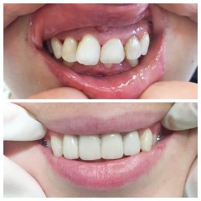 Incredible work (veneers)