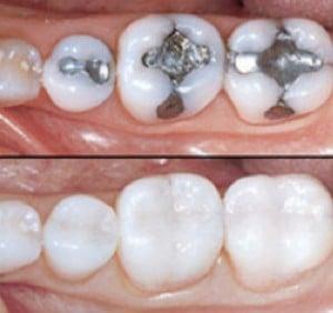 Amalgam fillings to Inlays (white fillings)