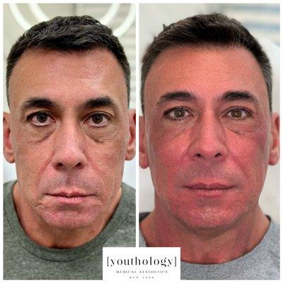 Sculptra Collagen Stimulation after two treatments!