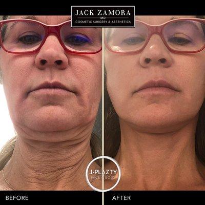 J-Plazty Face and Neck Lift by Jack Zamora, MD