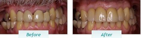 Implants and Crowns to Replace Defective Bridge