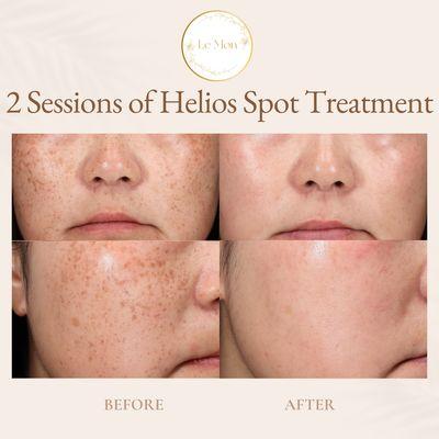 2 Sessions of Helios Spot Treatment