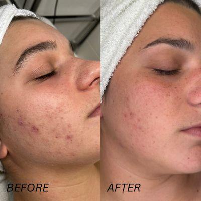 Acne client before and after