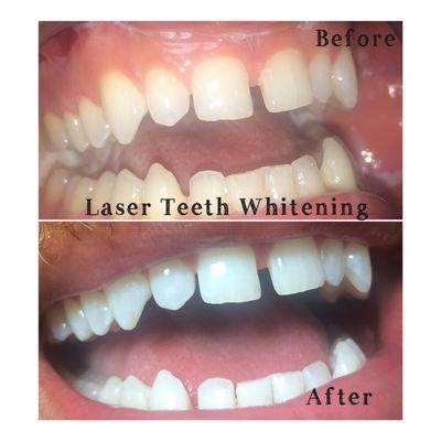 Laser Teeth Whitening