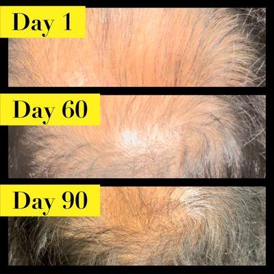 Tired of going bald? Try our 90 day hair Regrowth treatments starting at $99*