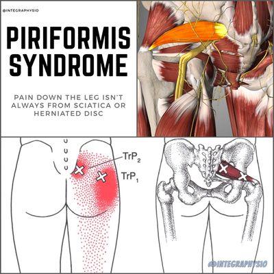 Have pain in your rear end and down the leg but doesn't quite go below the knee? This muscle could be the cause of your pain!