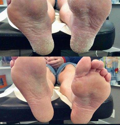 Check out this before & after photo from our Medical Pedicures.