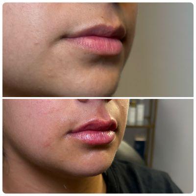 Beautiful, natural looking lip filler.