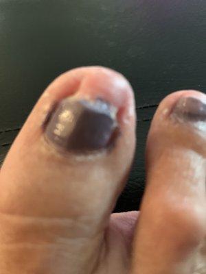 Toenail Dr Wagner trimmed