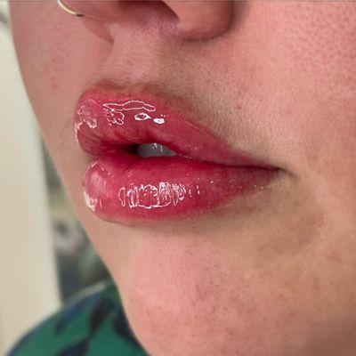 Juicy lips immediately following lip blushing permanent makeup