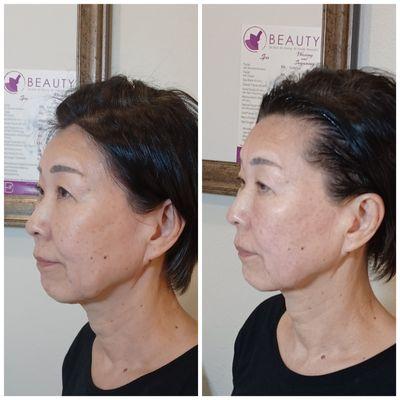 Non Surgical 7D Ultra Max Full face skin  lifting