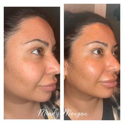 Glow up with a customized peel!