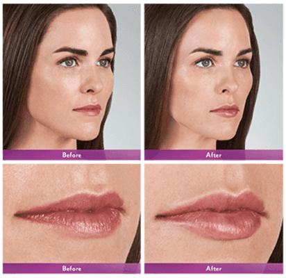 Subtle use of lip filler results in amazing differences that everyone will notice, but not suspect you had help.