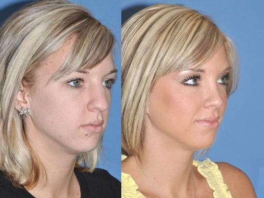 Natural appearing rhinoplasty result, in harmony with the patient's facial features by Dr. Vartanian.