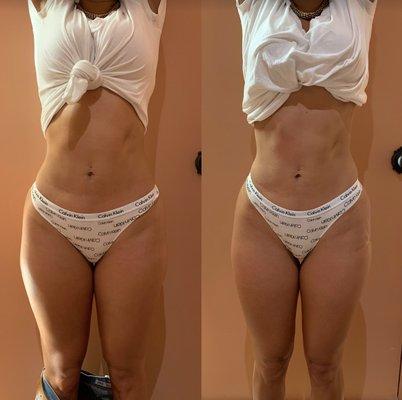 Before and After Body Contouring and More Services