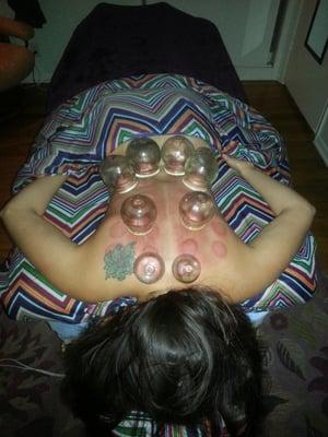 Fire Cupping-draws stagnation out of the body and leaves you with a sense of deep relief. Give it a try!