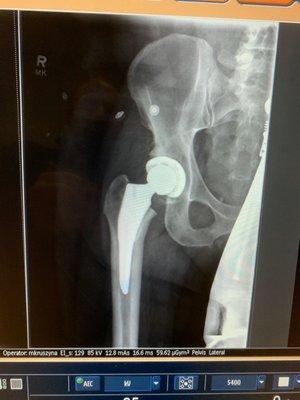 Actual hip implant.