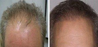 Dr. Simon of Vegas Valley Hair Restoration - Before and After photo