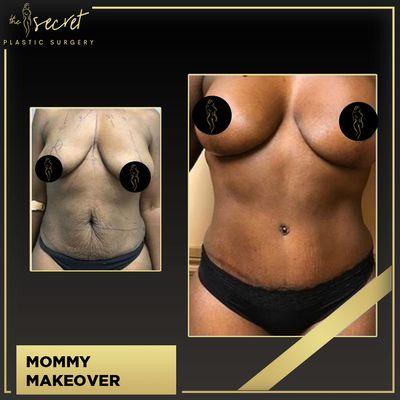 Mommy Makeover Miami - The Secret Plastic Surgery