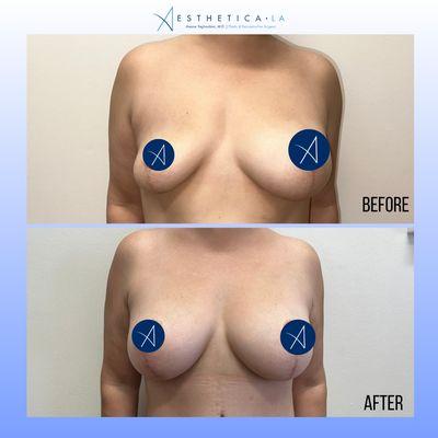 breast augmentation