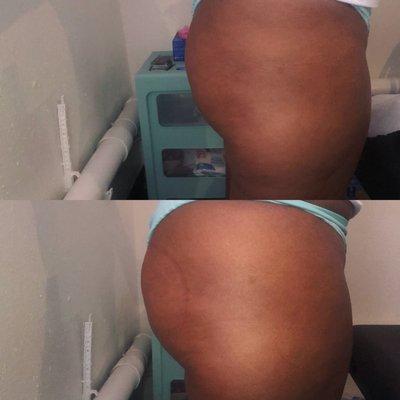 Vacuum therapy non surgical buttocks lift was performed for this treatment. After one 40 minute these amazing results were achieved.