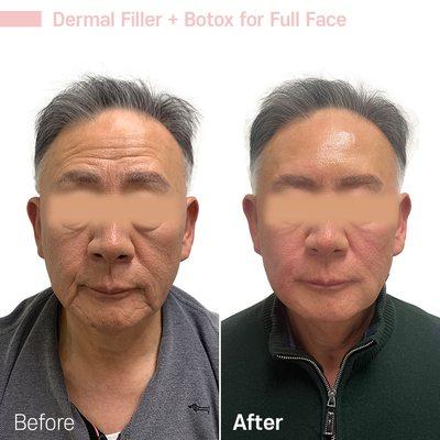 Contour Filler & Botox