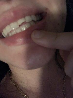 My ugly chipped tooth.