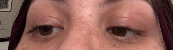 Redness and burns on eyelids (centers)