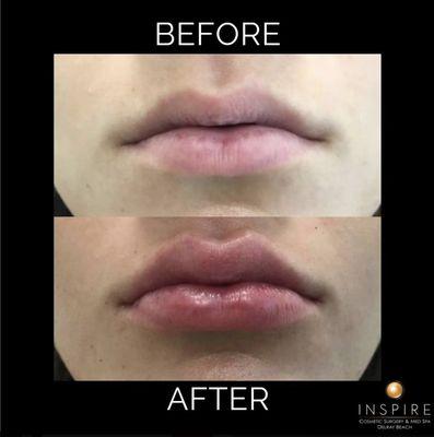 Before and after JUVÉDERM® Dermal Filler to reduce enhance and add volume to the lips at Inspire Cosmetic Surgery & Med Spa.