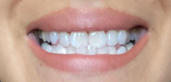 40 min whitening treatment