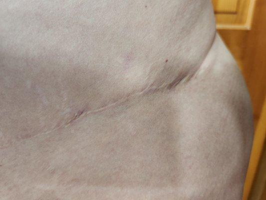 Left side of tummy tuck scar, causes underwear and bikini to fold into the crease.