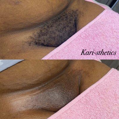 Brazilian wax before and after