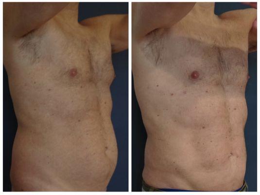 High definition liposuction, by Dr. Tim Neavin