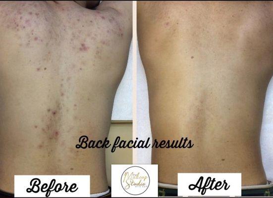 Book your back facial today. Available for men and women.