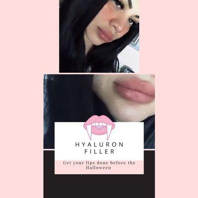 Hyaluron lip filler