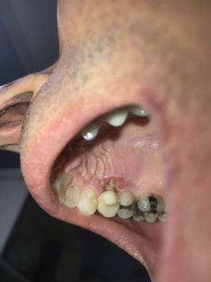 Another photo of gum tissue damage