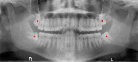 Tooth Extractions and Wisdom Teeth Removals