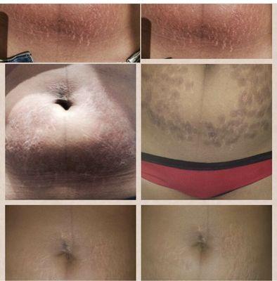 STRETCH MARKS TREATMENT IN ONLY 3 SECTION... TO BOOK YOUR FREE CONSULTATION PLEASE CALL US TODAY