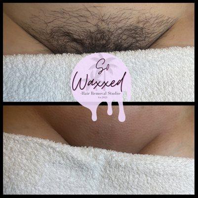 Brazilian Wax using hard wax made for sensitive areas.