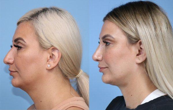 Rhinoplasty and Contour Neck Lift