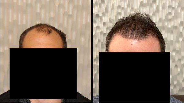 31 year old male 
FUT: 3,015 grafts 
18 month results