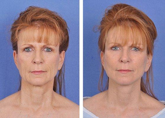 Facelift Before and After